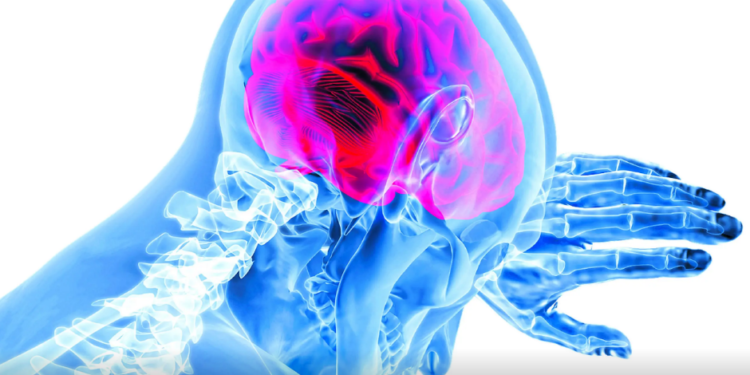 Enfermedad cerebrovascular es segunda causa de muerte en el mundo