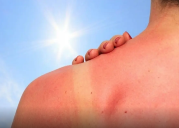 ¿Cómo tratar la piel quemada por el sol?