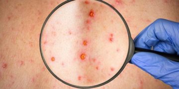 Salud Pública notifica primer caso sospechoso de viruela símica en República Dominicana